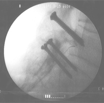 racz catheter procedure